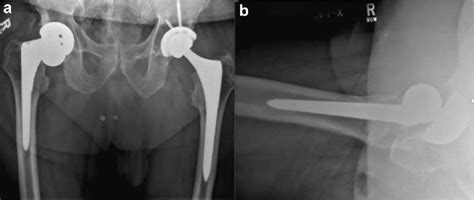 Anteroposterior Pelvis A And Lateral Hip Radiographs B From January