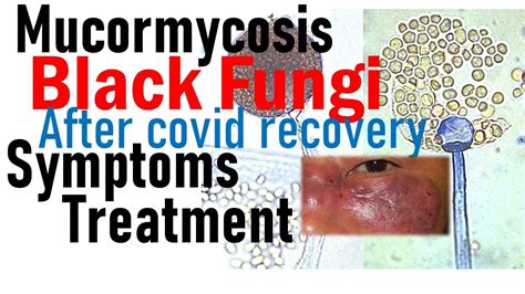 Mucormycosis Symptoms And Treatment After Covid The Black Fungus