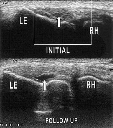 Partial Thickness Tear Common Extensor Tendon Longitudinal Image