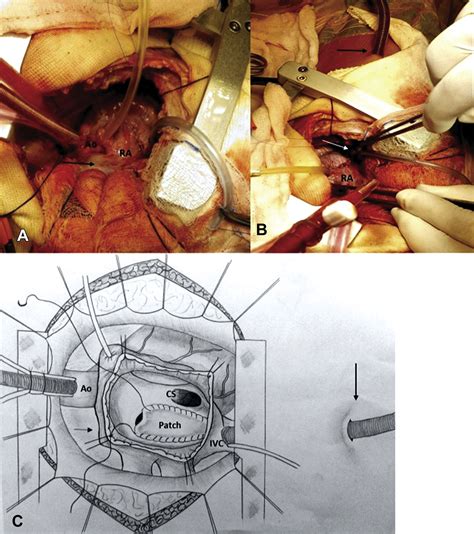 Right Posterior Thoracotomy For Open Heart Surgery In A Rare Morphology