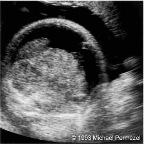 📃 Fetomaternal Hemorrhage Treatment By Intrauterine Transfusion