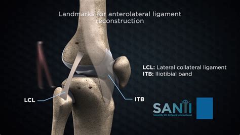 Anterolateral Extra Articular Procedures Combined With Acl Reconstruction Youtube