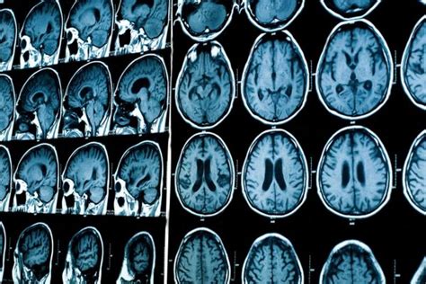 MS Has Distinct Subtypes Study Of MRI Brain Patterns Using AI Reports Multiple Sclerosis