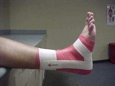 Check spelling or type a new query. Ankle Taping and Bracing: Overview, Periprocedural Care ...
