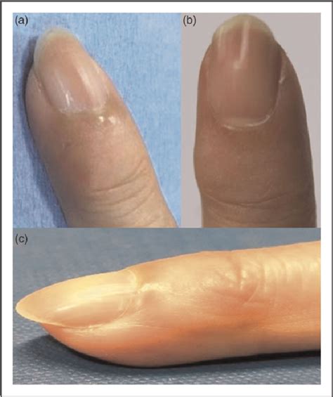 Figure 2 From Percutaneous Capsulotomy For Treatment Of Digital Mucous