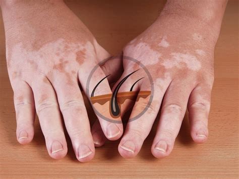 White Spots On Skin Myths And Facts About Vitiligo Dermacosm