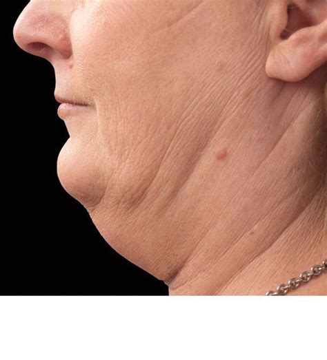 Double Chin Fat Removal Treatments London Bucks The Cosmetic Skin Clinic