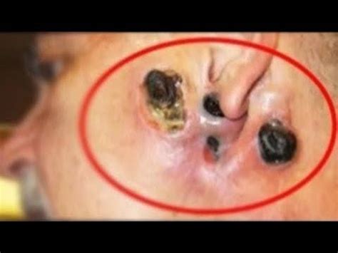Republican ags group sent robocalls urging march to the capitol. Big Blackheads 2 2020 - Pimple Popping Videos