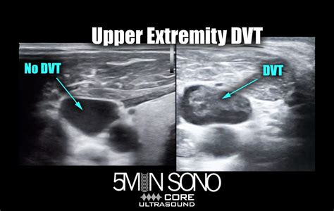 5 Minute Sono Upper Extremity Dvt Core Ultrasound
