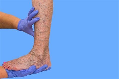 Venous Hypertension Or Venous Insufficiency What Is The Difference