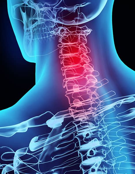 Neck Pain Relief With Myofascial Release Therapy A Holistic Approach