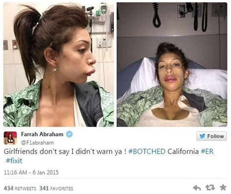 Porn Star Farrah Abrahams Plastic Surgery Goes Terribly Wrong She Owns It