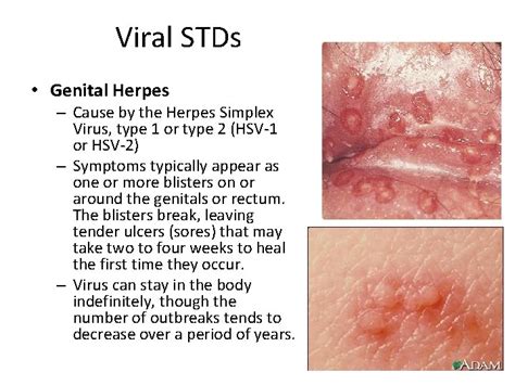 This Old House Stds That Cause Sores