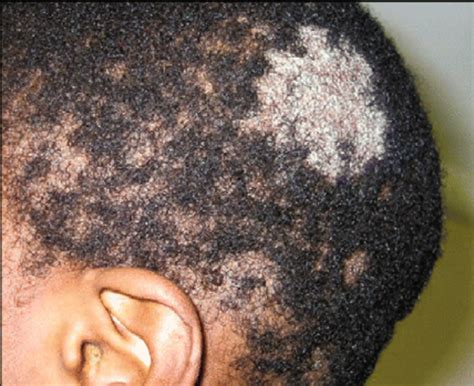 Tinea Capitis Showing Black Dots From Broken Hairs Download