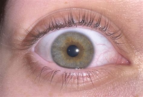 Are My Eyes Hazel Or Green With Central Heterochromia Ive Always