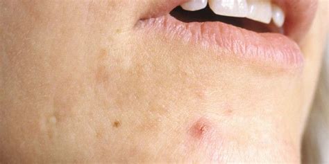 Everything You Ever Wanted To Know About Cystic Acne Pimples On Chin
