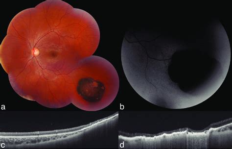 Congenital Hypertrophy Of The Retinal Pigment Epithelium Chrpe A