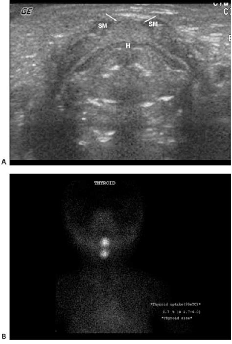 Ectopic Thyroid In A 3 Week Old Boy A Transverse Sonogram Shows A