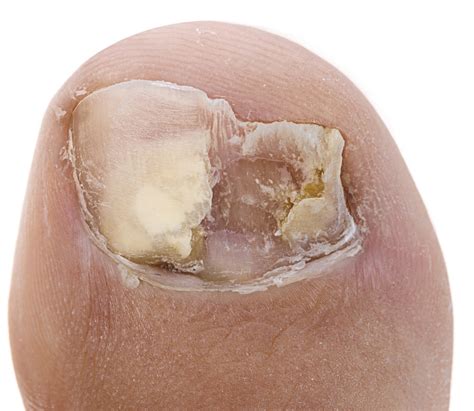 Really Bad Toenail Fungus Causes Home Remedies And Best Treatment