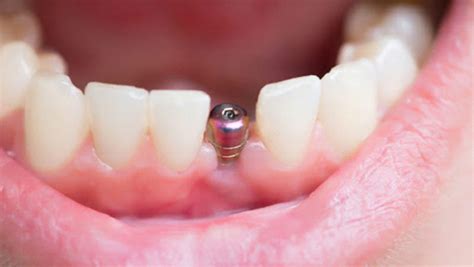 How Long Do Dental Implants Last Crawford And O Brein Dentagama