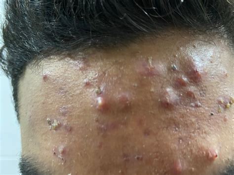 Difficult Acne Treatment In Islamabad Islamabad Dermatologist Dr