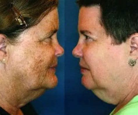 what 7 smoker vs nonsmoker identical twins look like after many years of smoking