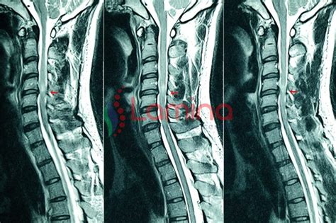 Saraf Leher Kejepit Lamina Pain And Spine Center