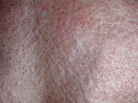 Pustular Psoriasis Causes Risk Factors Symptoms And Types