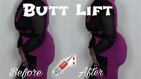 Butt Lift Illegal Butt Shots Bbl S Let S Talk Butts And Tips Youtube