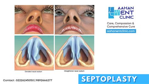 Nasal Polyps Deviated Septum