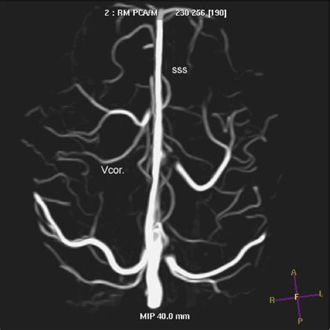 Figure 1 From Trombosis Venosa Cerebral Hallazgos En Imagen Semantic