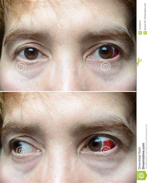 Woman With Burst Blood Vessel In Eye Stock Image Image Of Closeup