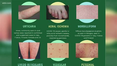 Doctor Skin Rash Could Be A Symptom As Possible Covid 19 Symptom