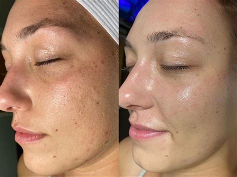 HydraFacial Before And After Pictures Case Chico Yuba City Oroville CA Hodari MD