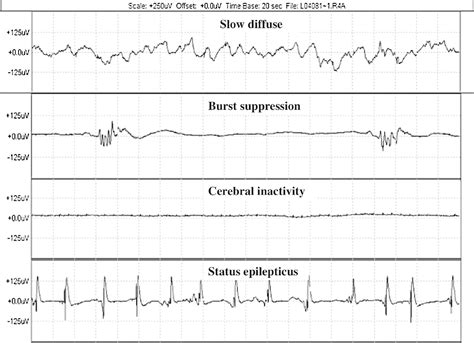 The Validation Of Simplified Eeg Derived From The Bispectral Index