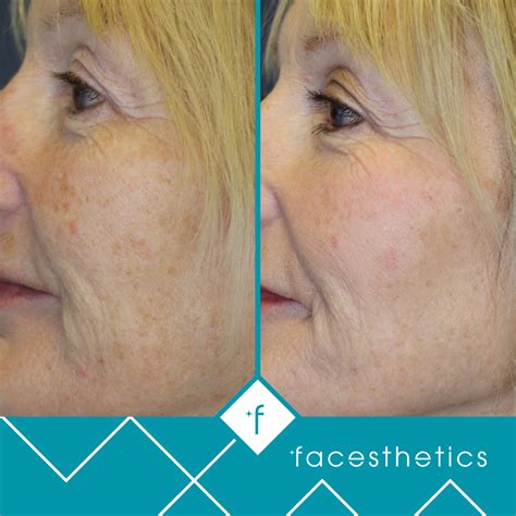 Skinpen Microneedling Facesthetics