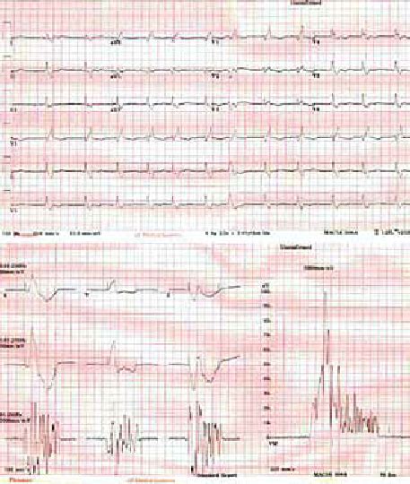 A 12 Lead Electrocardiogram Ecg And Signal Averaged Electrocardiogram