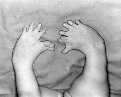 Thalidomide Deformity Photograph By Otis Historical Archives National