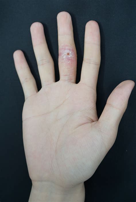 A Chronic Painless Plaque On The Finger The Bmj