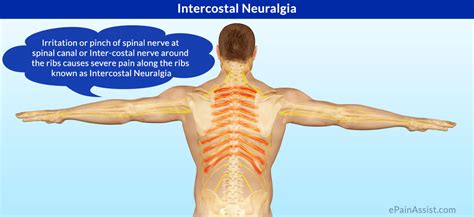 What Is Intercostal Neuralgiasymptomscausestreatmentpathophysiology