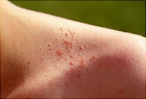 Common Summer Diseases And Ways To Prevent Them