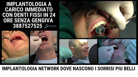 Implantologia A Carico Immediato Padova Youtube