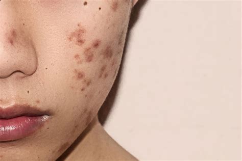 Ask A Dermatologist How To Heal And Prevent Acne Scars The Dose