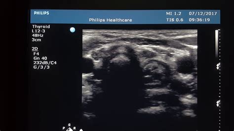 Thymus Gland Ultrasound