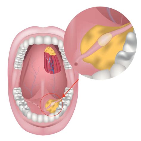 What You Need To Know About Salivary Gland Disorders Annapolis And