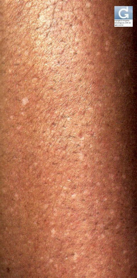 Idiopathic Guttate Hypomelanosis Igh Global Dermatology