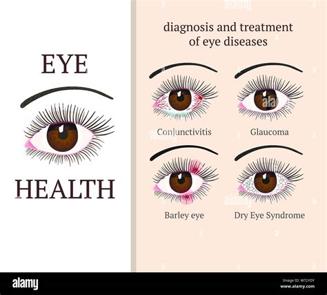 Eye Disease Most Common Eye Problemc Conjunctivitis Glaucoma Dry