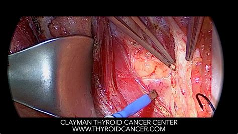 Thyroid Cancer Spread To Lymph Nodes Youtube