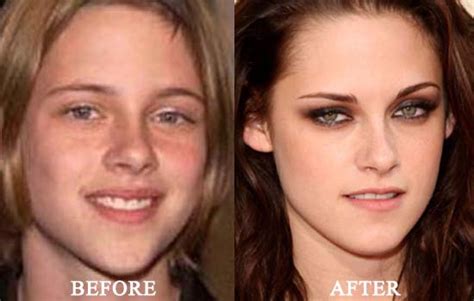 Kristen Stewart Before And After Breast Implants