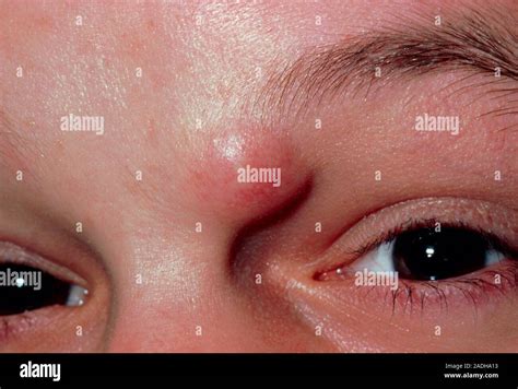 Close Up Showing A Sebaceous Cyst Near The Eyebrow Of A Patient The